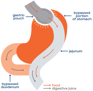 Gastric Bypass Diagram