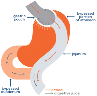 Gastric Bypass Diagram