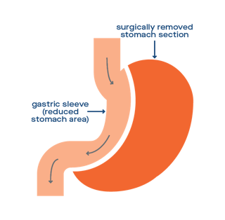 Sleeve Gastrectomy