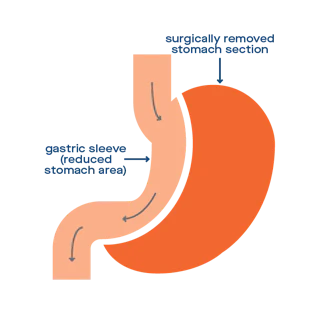 Sleeve Gastrectomy